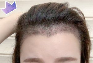 -大麦微针植发丨全国连锁