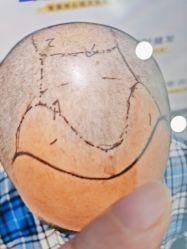 体验前-大麦微针植发全国连锁