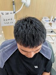 -大麦微针植发丨全国连锁