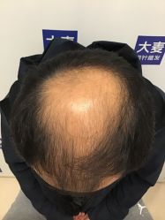 -大麦微针植发丨全国连锁