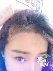 -大麦微针植发全国连锁