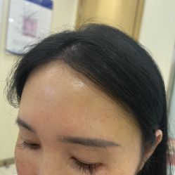 -碧莲盛·不剃发植发
