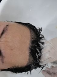 -大麦微针植发全国连锁