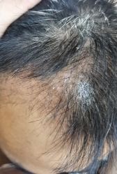 点击看大图 体验后-熙朵美学植发连锁