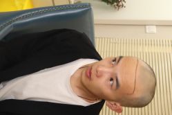 点击看大图 -大麦微针植发丨全国连锁