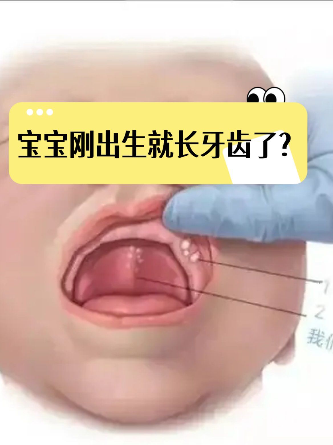 宝宝出生后牙龈上冒出的小白点是牙齿吗