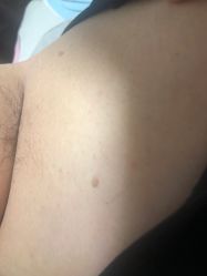 -爱莎扁平疣·汗管瘤·斑痣中心