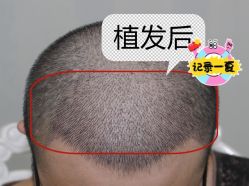 -大麦微针植发全国连锁