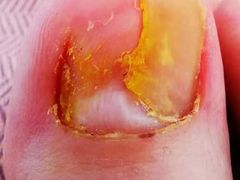 -祖传修脚甲沟炎灰指甲鸡眼