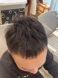 点击看大图 -碧莲盛·不剃发植发