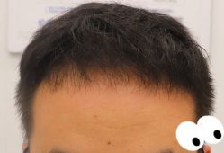 -大麦微针植发全国连锁