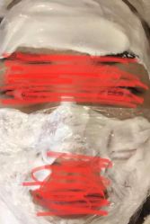 点击看大图 体验前-深圳春天阳光医院·轮廓抗衰中心