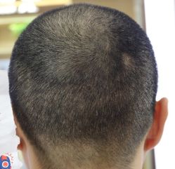 -大麦微针植发丨全国连锁