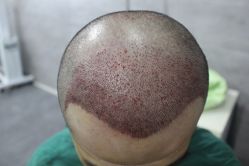 点击看大图 -大麦微针植发丨全国连锁