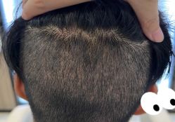 -大麦微针植发全国连锁