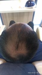 体验后-大麦微针植发丨全国连锁