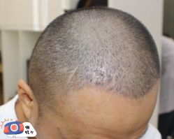 -大麦微针植发丨全国连锁