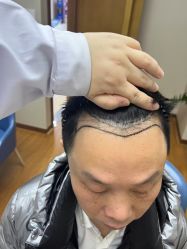 体验前-大麦微针植发全国连锁