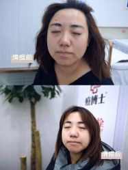 -悟空祛痘·诺奖技术专业店