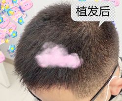 -大麦微针植发全国连锁