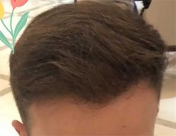 点击看大图 -大麦微针植发全国连锁