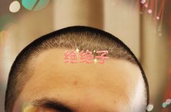 -大麦微针植发全国连锁