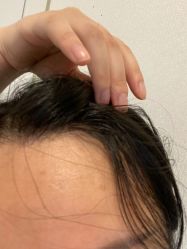 -大麦微针植发丨全国连锁