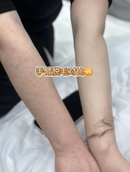 -薇兰专业脱毛连锁机构