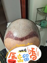 -大麦微针植发全国连锁