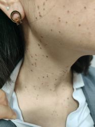 -北京美痣堂古方祛痣斑疣瘊