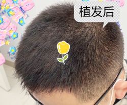 -大麦微针植发全国连锁