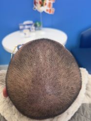 体验后-大麦微针植发全国连锁