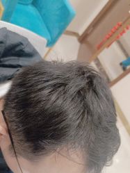 -碧莲盛·不剃发植发