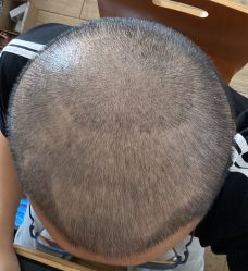 -大麦微针植发丨全国连锁