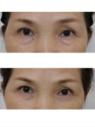 -广州健丽·去眼袋医疗美容机构