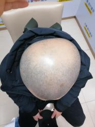 -大麦微针植发丨全国连锁