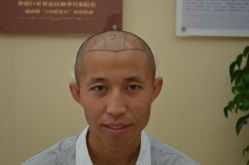 -大麦微针植发丨全国连锁