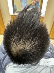 -大麦微针植发全国连锁