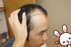 -大麦微针植发丨全国连锁