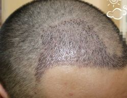 -大麦微针植发丨全国连锁