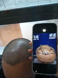 -碧莲盛·不剃发植发