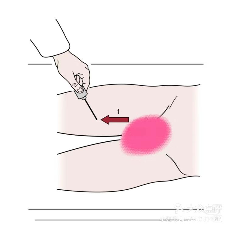 仁勇机智的小超 6月11日 15:38 关注 反射#康复 #健身指导提睾反射