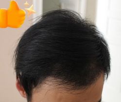 -大麦微针植发丨全国连锁