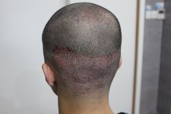 点击看大图 -大麦微针植发丨全国连锁