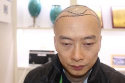 点击看大图 -大麦微针植发丨全国连锁