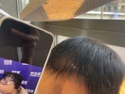 -碧莲盛·不剃发植发