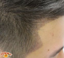 -大麦微针植发丨全国连锁