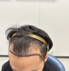 -大麦微针植发全国连锁