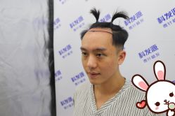 点击看大图 -大麦微针植发丨全国连锁