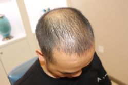 -大麦微针植发丨全国连锁